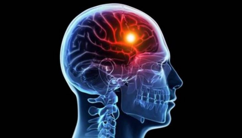 Εγκεφαλικό: Τα 5 σημάδια που όλοι πρέπει να γνωρίζουμε