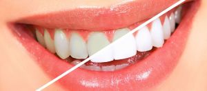Λαμπερό χαμόγελο: Τα λάθη που κάνεις και πώς θα αποκτήσεις λευκά δόντια